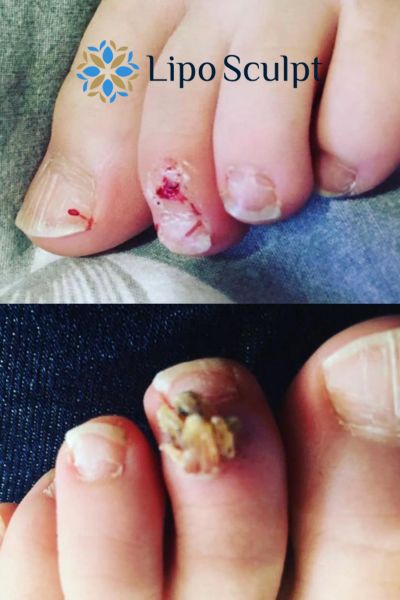 Wart removal customer results from Lipo Sculpt London